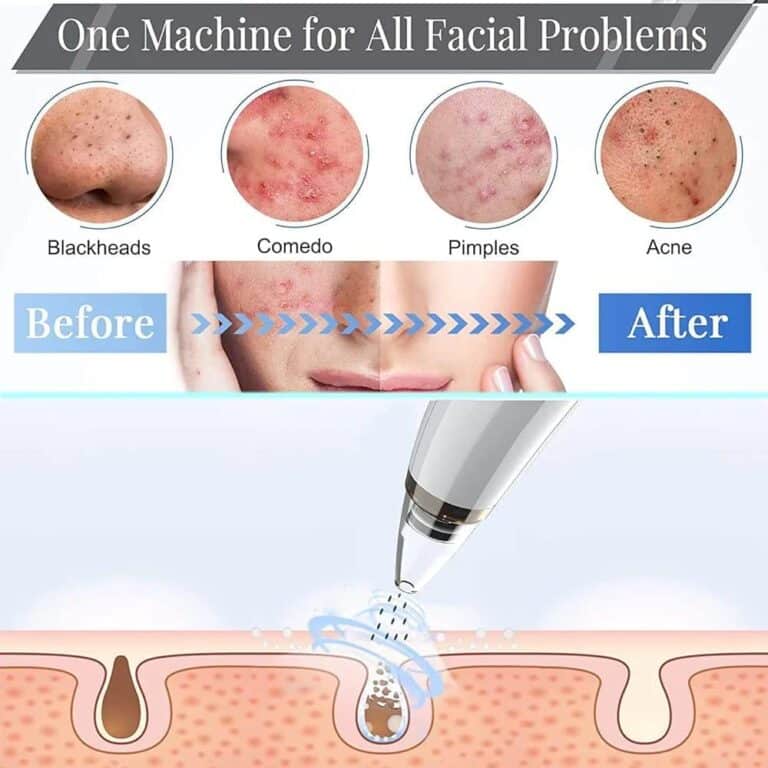 Blackhead remover 2